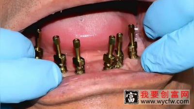 下半口种植Allon6二期取模流程分享