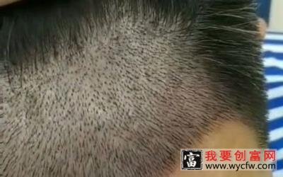男士微针植发技术种植，术后第7天效果